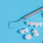 Dental Veneers for Missing Teeth